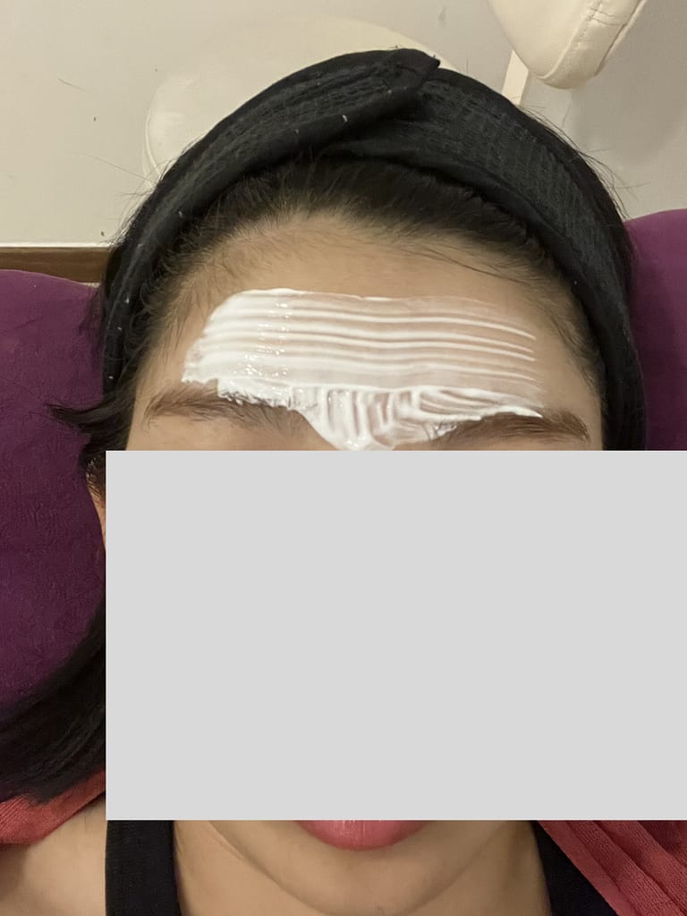 麻酔の様子の写真